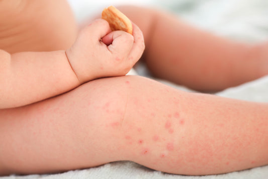 Your Ultimate Baby Rash Guide: Understanding and Soothing Common Infant Skin Woes